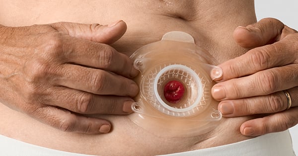 Konvexe Versorgung für Urostoma